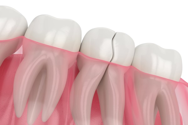 Restoring A Broken Tooth With A Crown