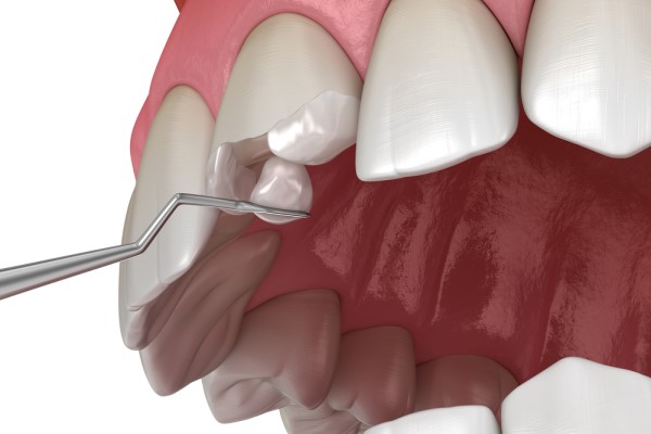 Cosmetic Dental Repair Options For A Broken Tooth