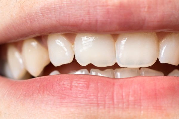 What Can Happen After A Chipped Tooth
