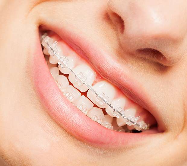 Grand Blanc Clear Braces