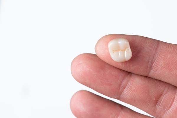 What Is A Dental Crown?
