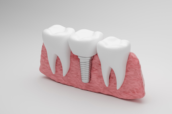 A Step By Step Guide To Getting An Implant Crown