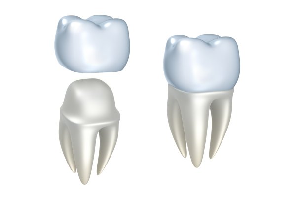 dental implants Grand Blanc, MI