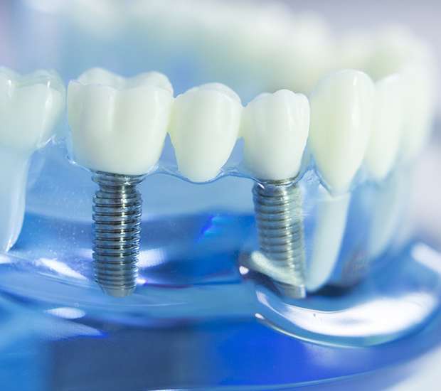 Grand Blanc Dental Implants