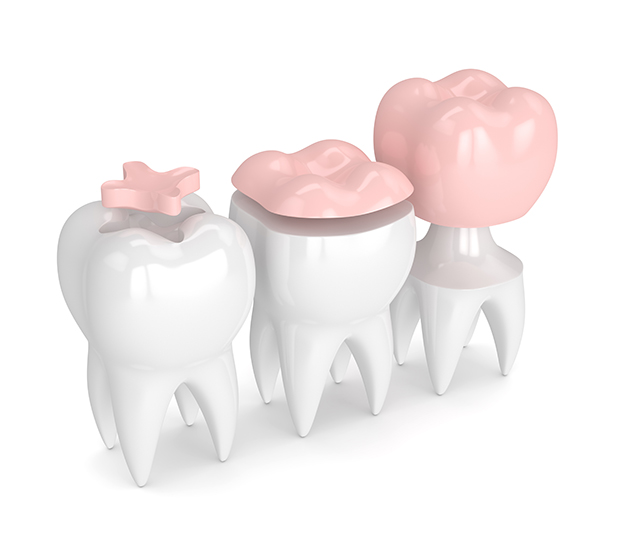 Grand Blanc Dental Inlays and Onlays