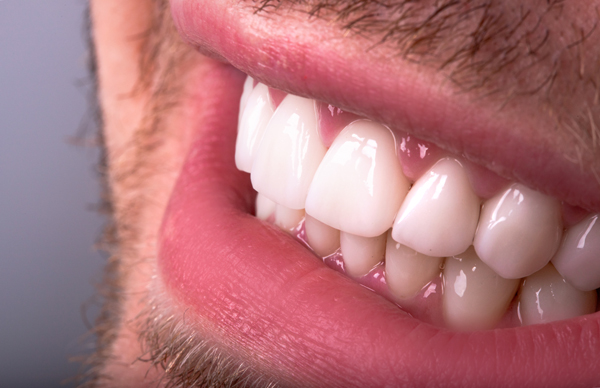Everything You Need To Know About Dental Veneers