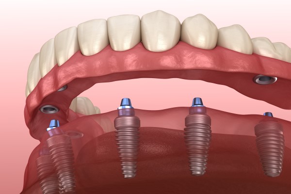Fixed Dentistry Options For Tooth Replacement: Dentures