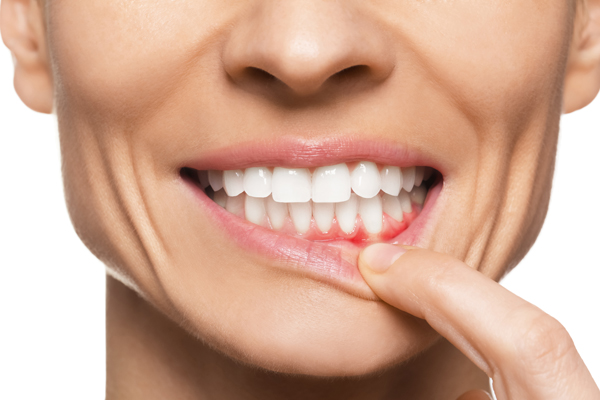 Periodontics: Protecting The Gums For A Healthier Smile