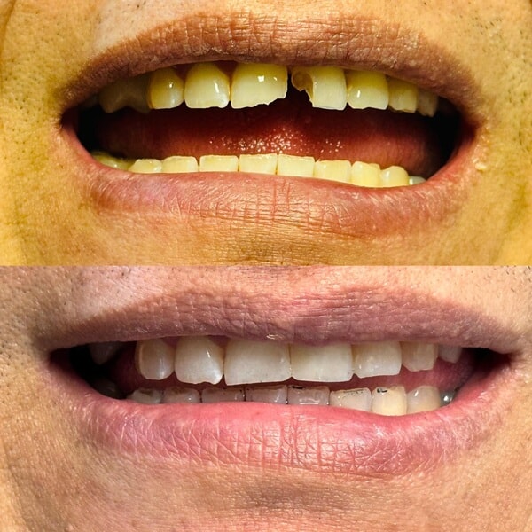 Composite Restoration