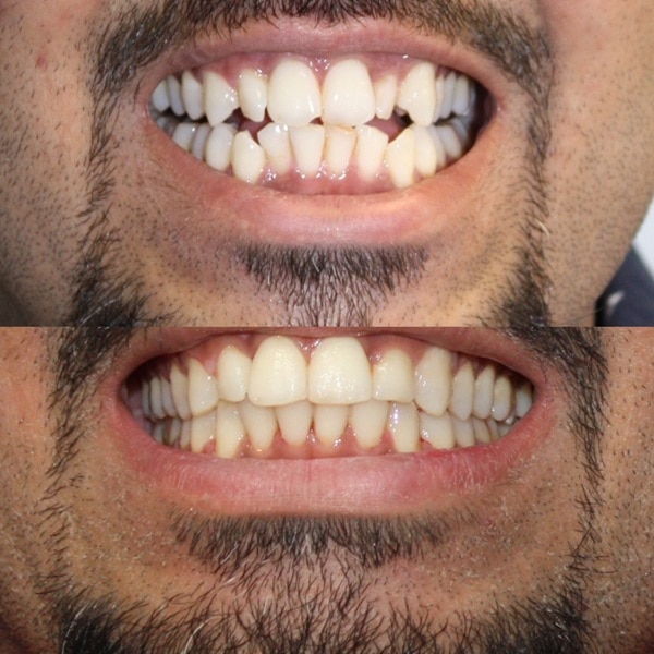 Invisalign