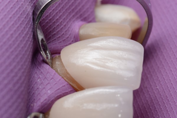 What Type Of Materials Are Used For A Snap On Smile?