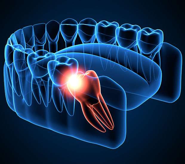 Grand Blanc Wisdom Teeth Extraction